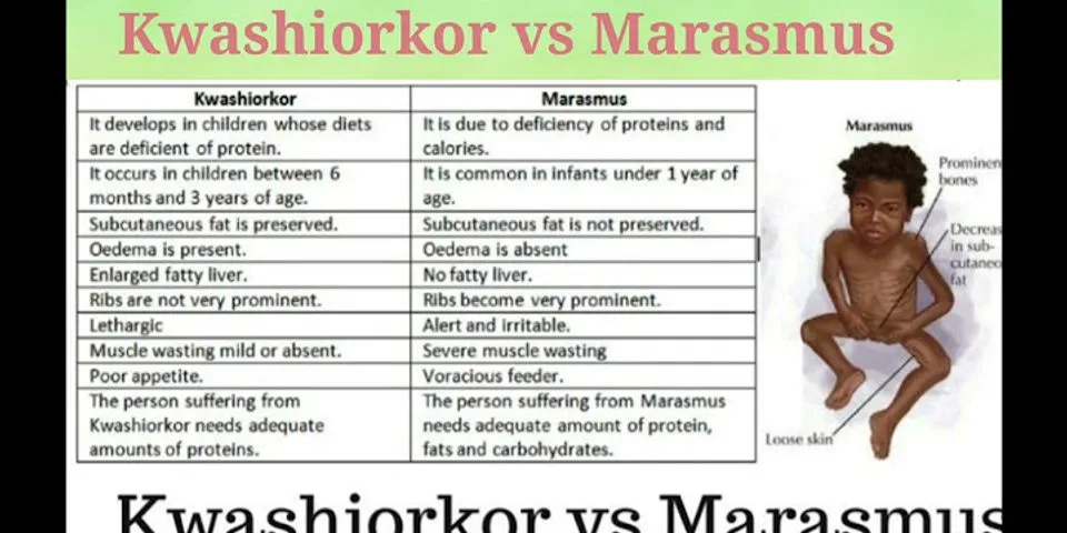 Jelaskan perbedaan antara penyakit Marasmus dan kwashiorkor